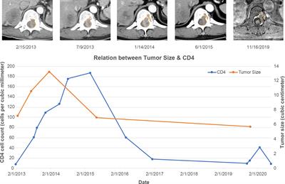 Epstein-Barr Virus-Associated Smooth Muscle Tumor and Its Correlation With CD4 Levels in a Patient With HIV Infection